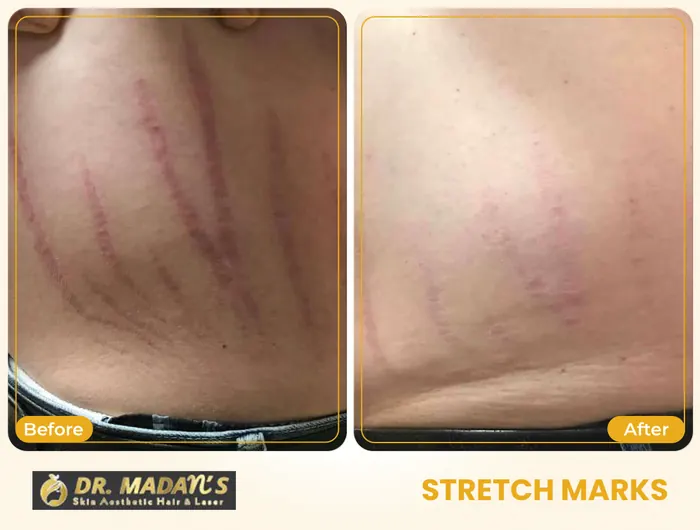 Stretch marks before and after result 11 at Dr Madan Aesthetics